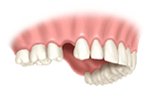 Perfect Smile single tooth missing